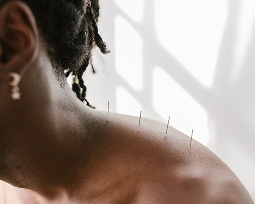 Acupuncture